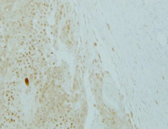 Immunohistochemical staining using microphthalmia antibody on formalin-fixed, paraffin embedded EWS/ATF1-induced tumor cells (scale bar 100 µm). (Image modified from original taken from product specific reference 2)